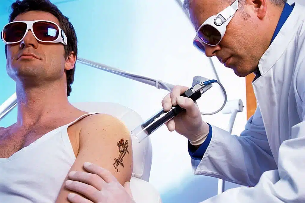 eliminacion de tatuajes con laser