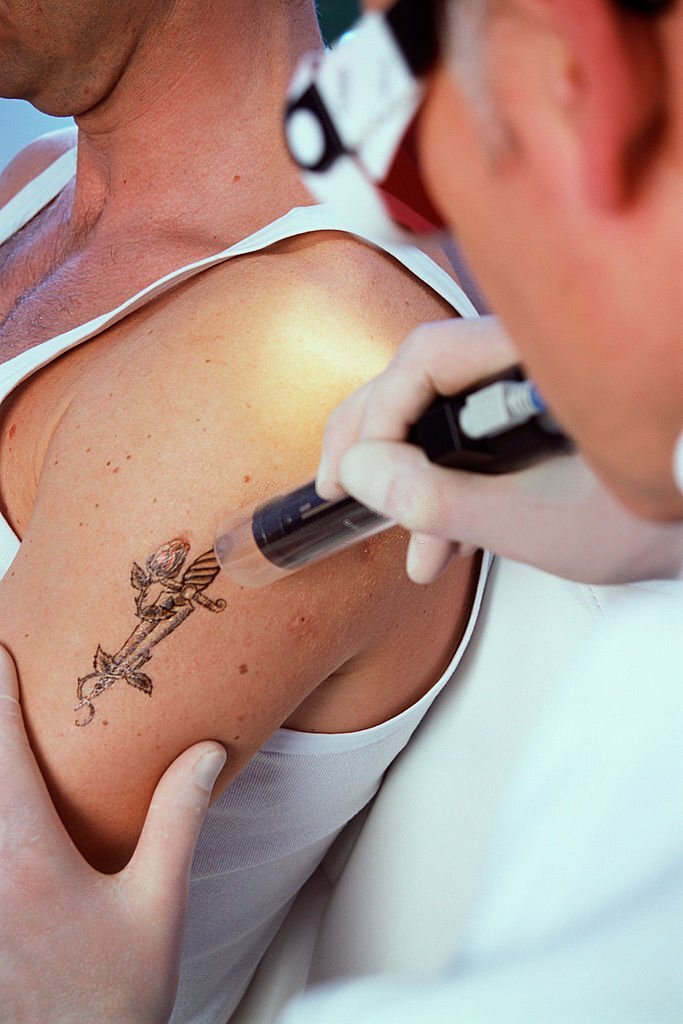 Eliminar los tatuajes con láser