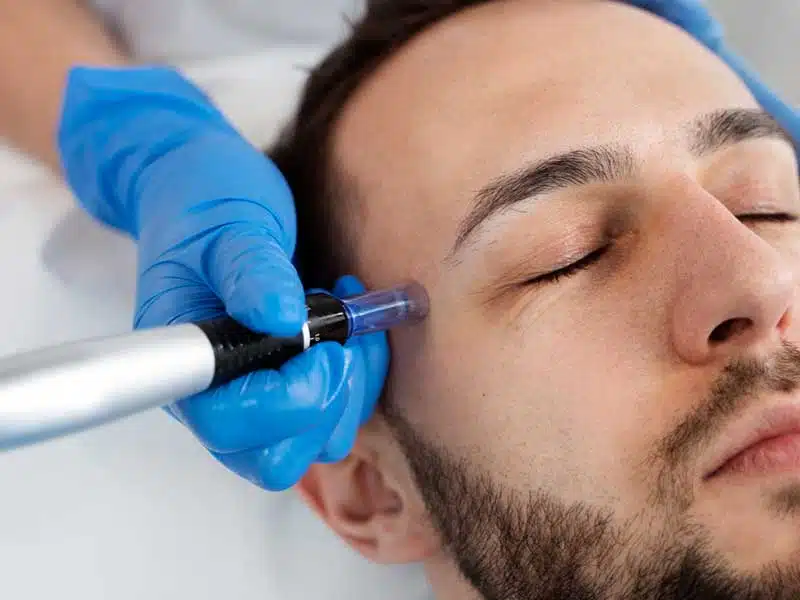 dermapen