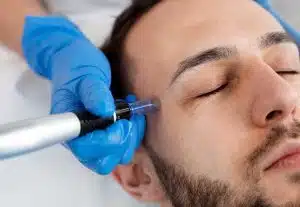 Dermapen barcelona