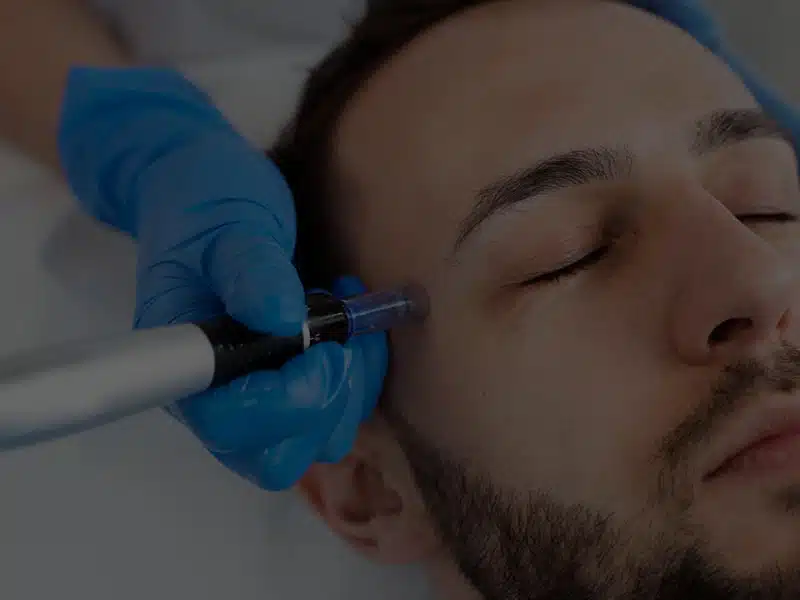 dermapen Barcelona