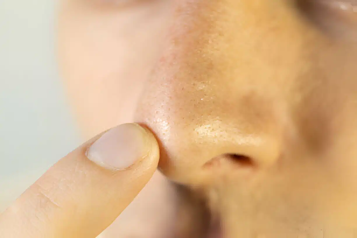 piel grasa en hombres