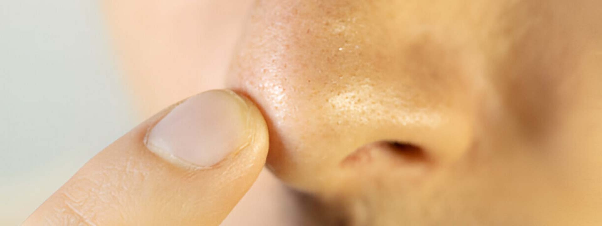 piel grasa en hombres