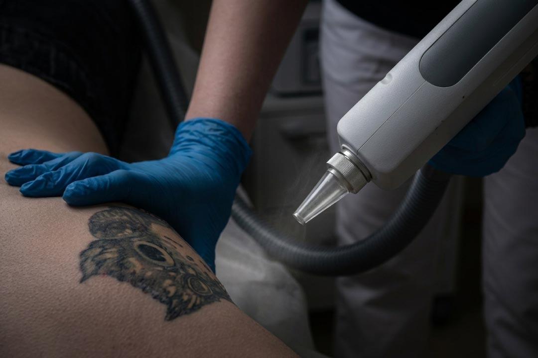 Eliminar tatuajes Barcelona
