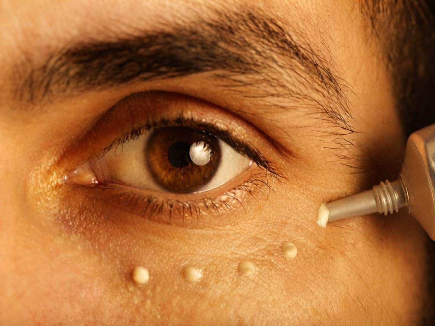 tratamiento anti ojeras